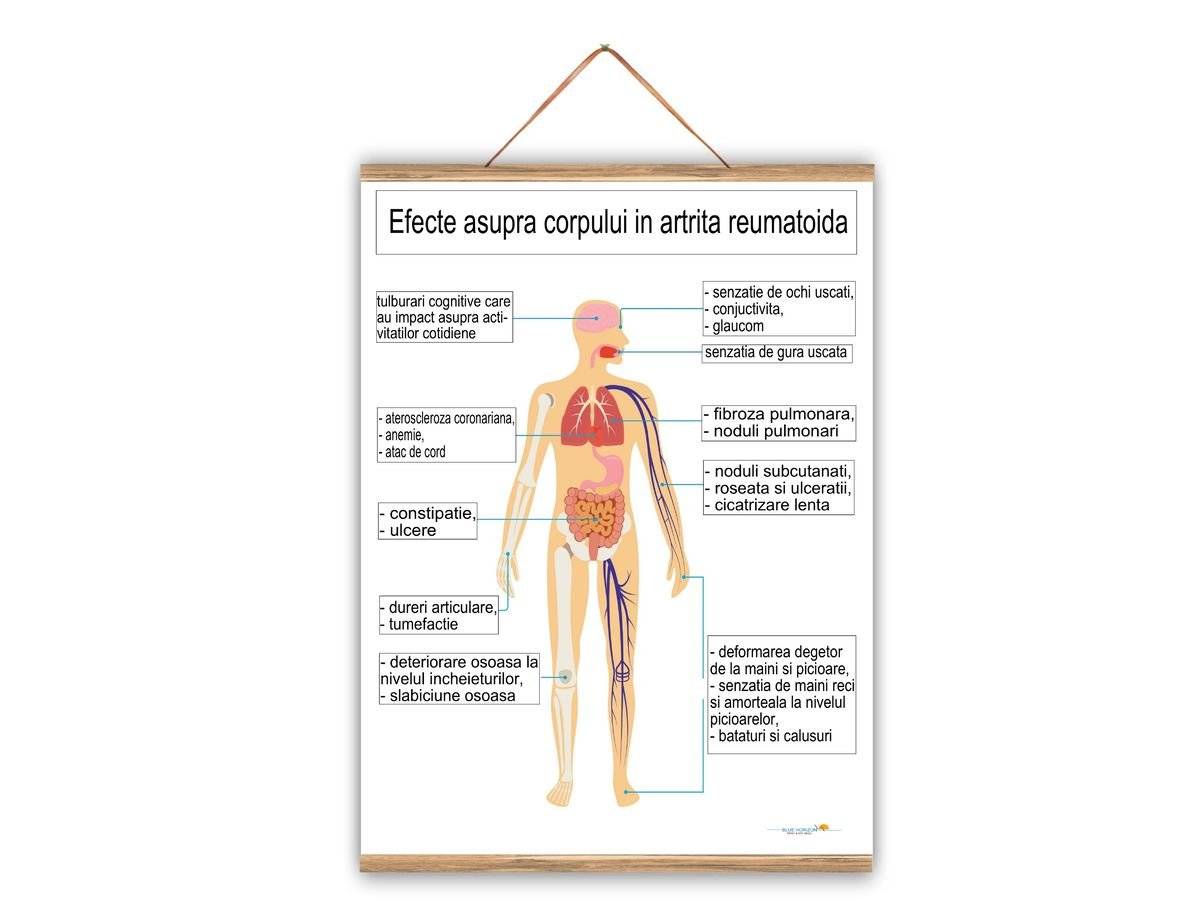 Plansa medicala - Artrita (Efecte și Modificări Articulare)