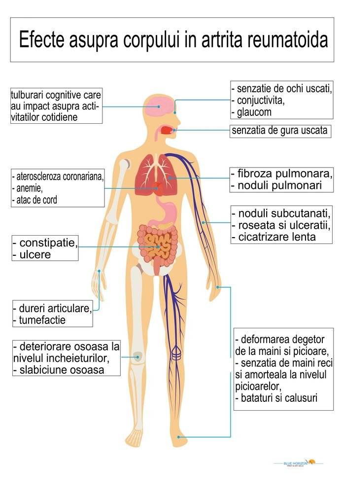 Plansa tematica - Artrita, efecte