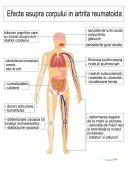 Plansa medicala - Artrita (Efecte și Modificări Articulare)